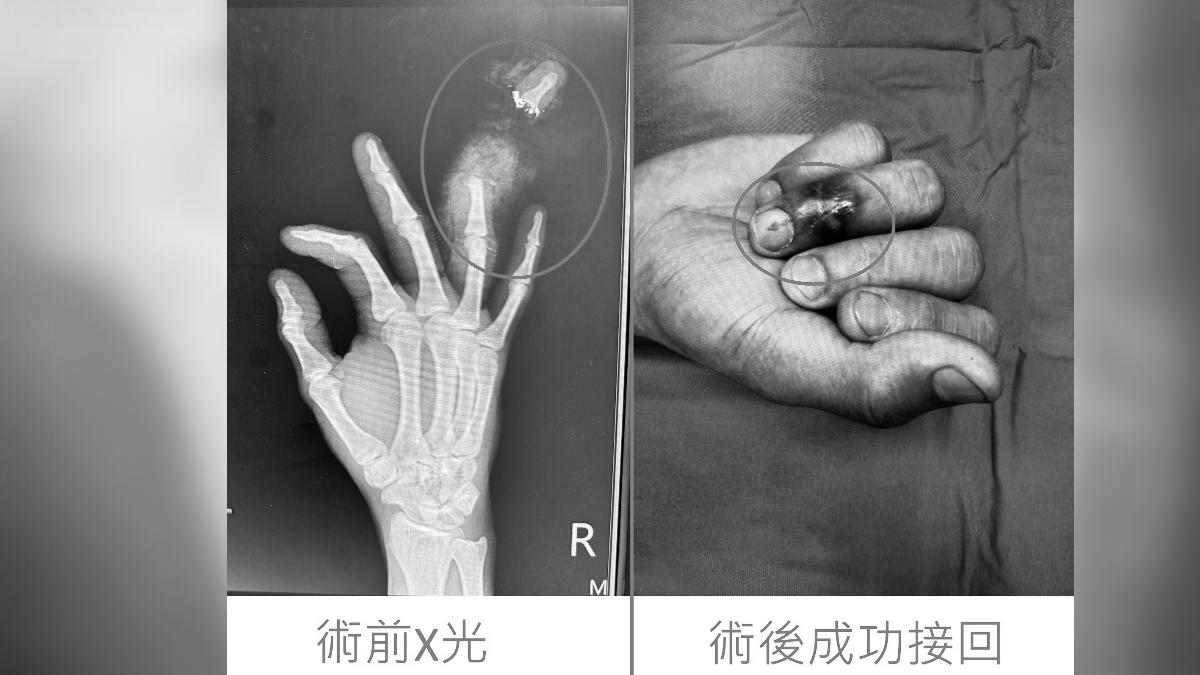 阿里於工廠打掃機台時,不慎誤觸開關,結果左手無名指末節遭捲入。(圖/烏日林新醫院提供)