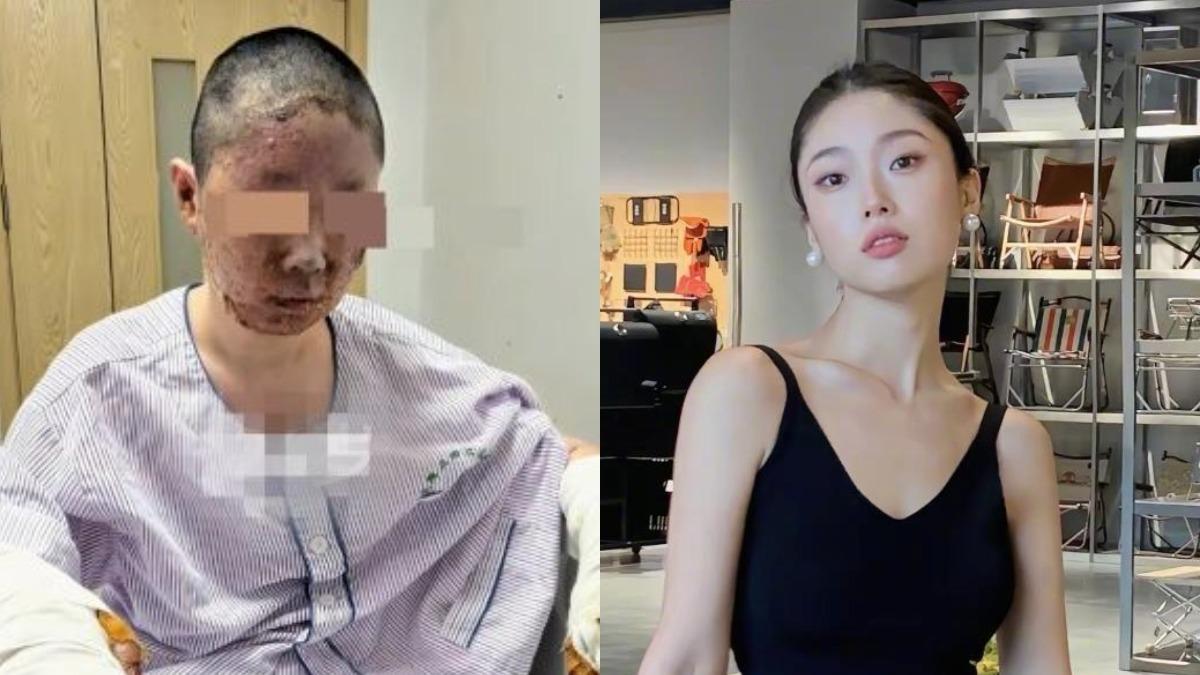 大陸27歲美妝網紅燒傷毀容，拍影片補貼醫藥費。（圖／翻攝自微博）