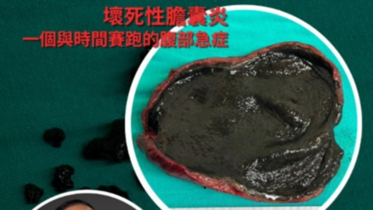 肚痛竟是壞死性膽囊炎「死亡率17.8%」 醫揭5大風險指標