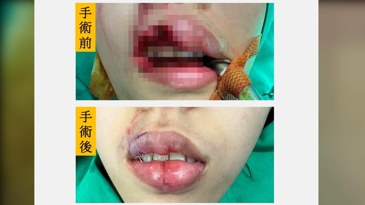 台中女大生遭愛犬猛咬!血染上嘴唇慘毀容 三分之一沒了