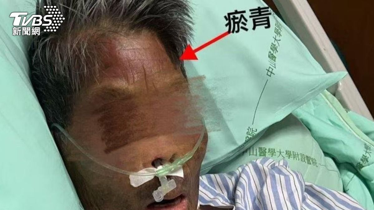 阿嬤臉上有多處瘀青。(圖/TVBS)