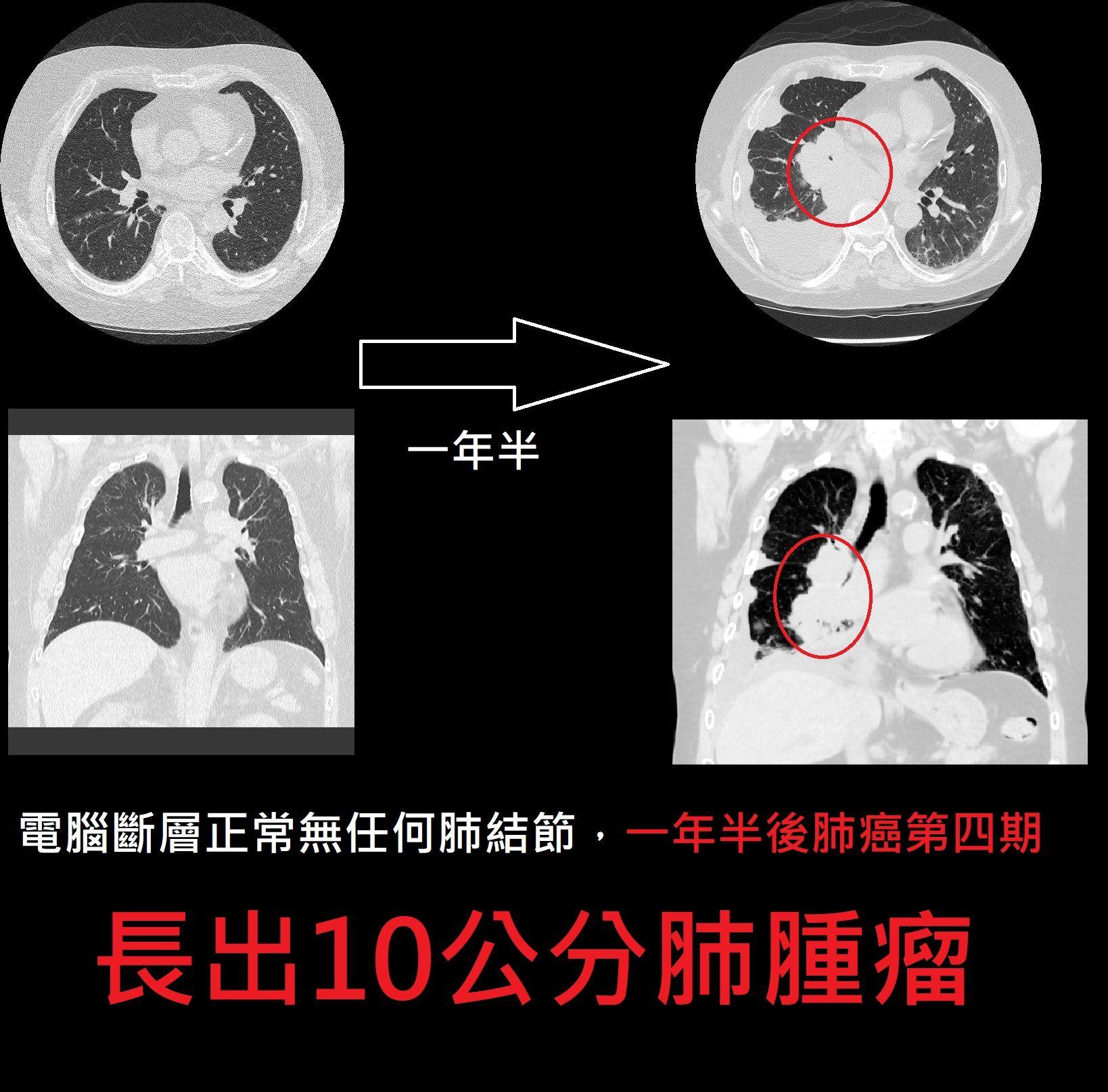 男子一年半後確診肺癌第四期。（圖／翻攝蘇一峰臉書）