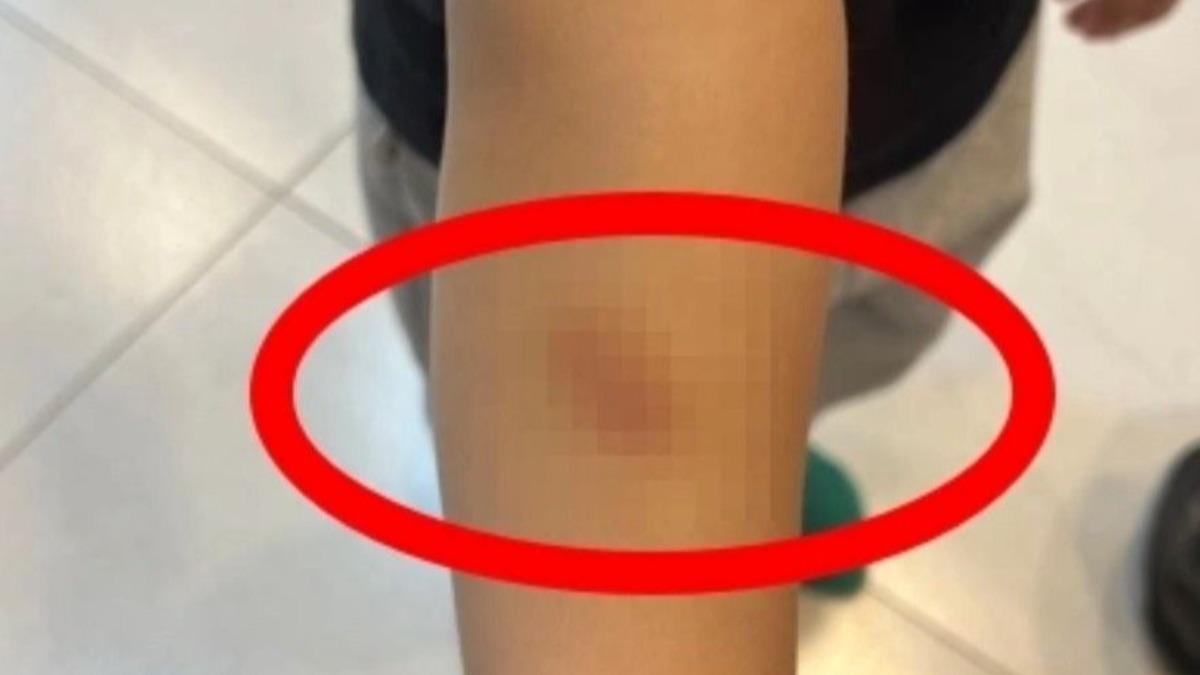 男童帶傷回家,家長質疑幼園管教不當。(圖/家長提供)