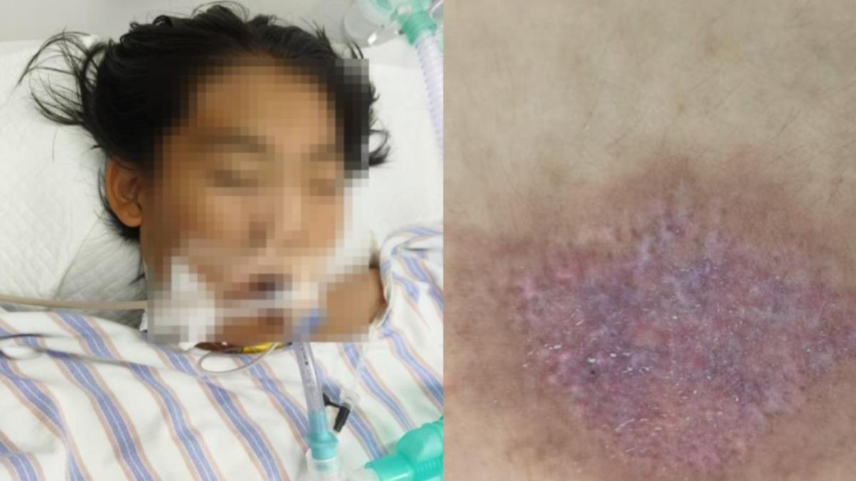 14歲王姓少女在夏令營慘遭虐待,全身是傷外,最終暴斃身亡。(組圖/翻攝自 微博@新聞晨報)