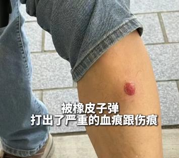 攝影記者被橡皮子彈打中。(圖/翻攝自新華社)