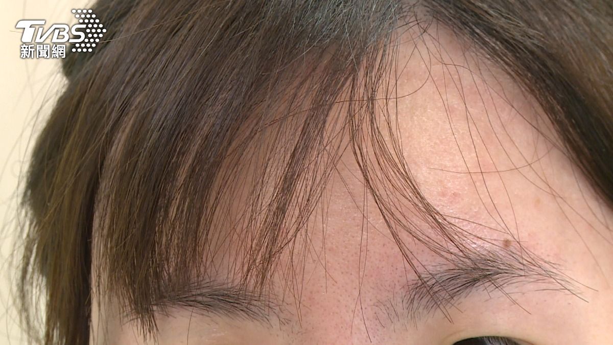 頭皮屑增多 醫師:當心脂漏性皮膚炎!