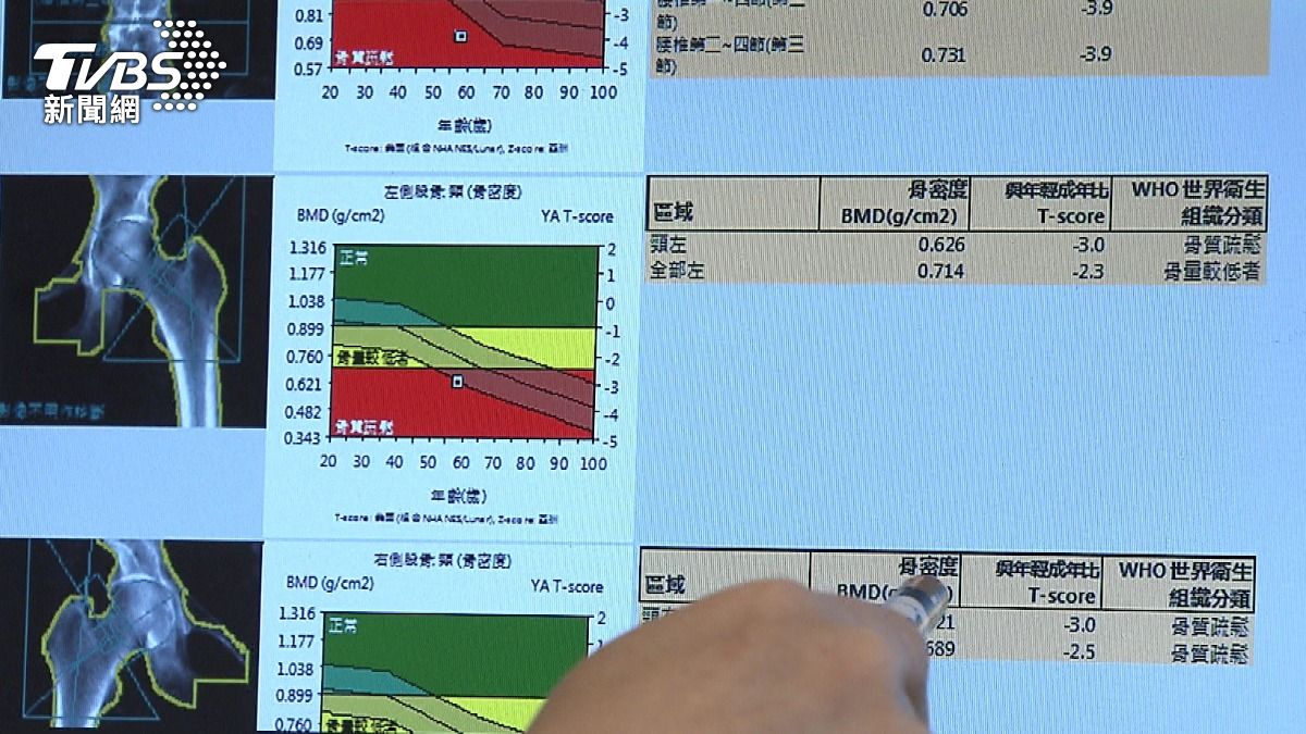 骨科醫師:遺傳與骨質疏鬆有關 (圖/TVBS)
