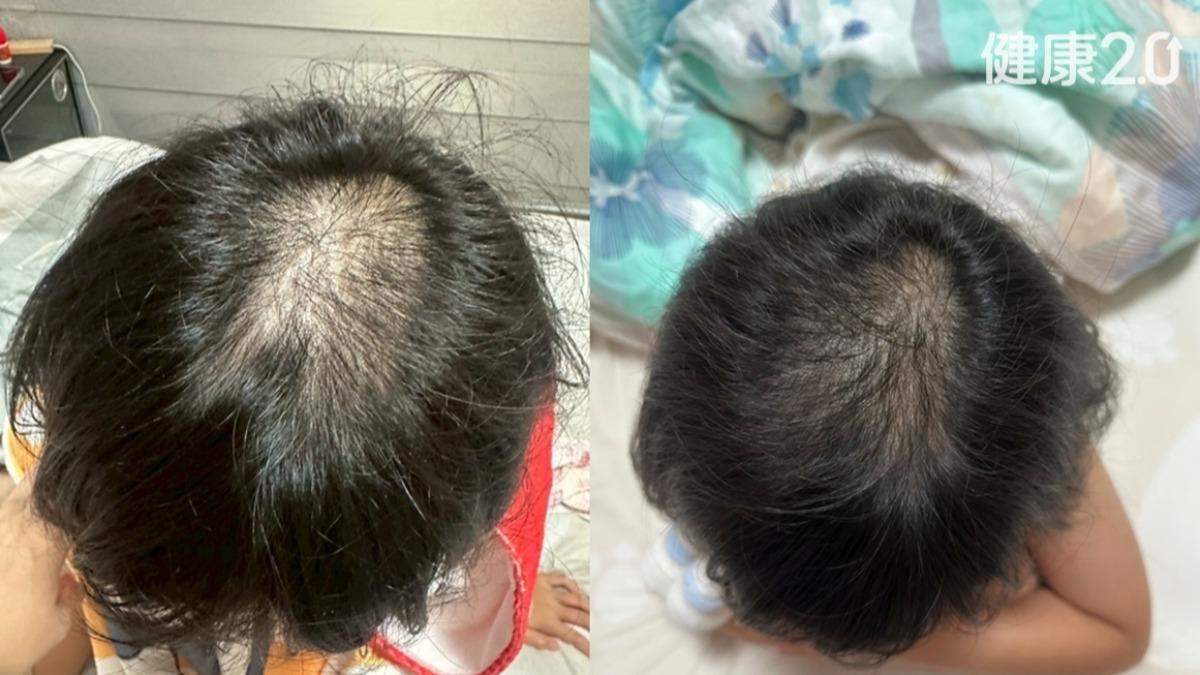 幼童使用芽孢桿菌益生菌產品後,頭皮濕疹與掉髮狀態明顯改善,搔癢不適情況也逐漸穩定。(圖/羅晞蕾提供)
