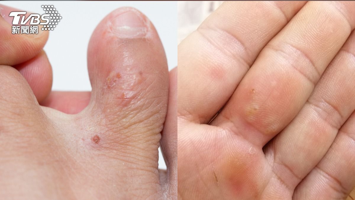 抓到破皮還在癢！醫揭「汗皰疹」反覆發作真相　止癢關鍵一次看