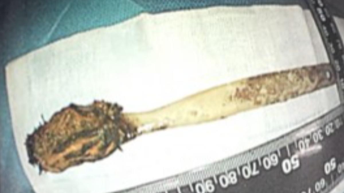 陸老翁胸痛就醫!驚見「牙刷藏肚52年」 他坦言:以為會消化