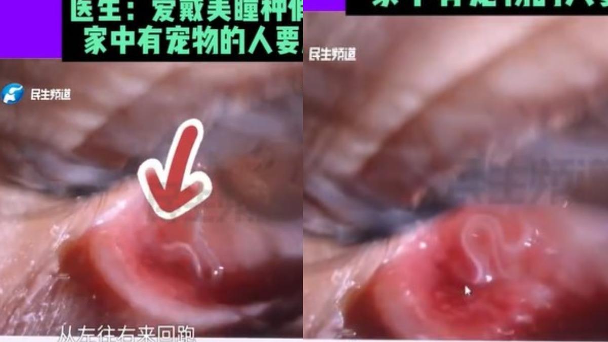 醫師檢查後確認,女子眼皮下的白色寄生蟲為結膜吸吮線蟲。(圖/翻攝自微博)