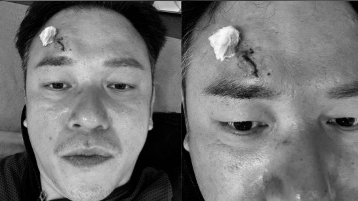 阿Ben曬出傷照。（圖／翻攝自白吉勝&徐小可 Love 白宮這一家 Pai’s Family臉書）