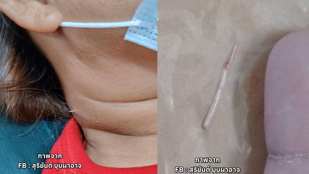婦人誤吞魚刺!照X光找不到 2週後「頸部被貫穿」