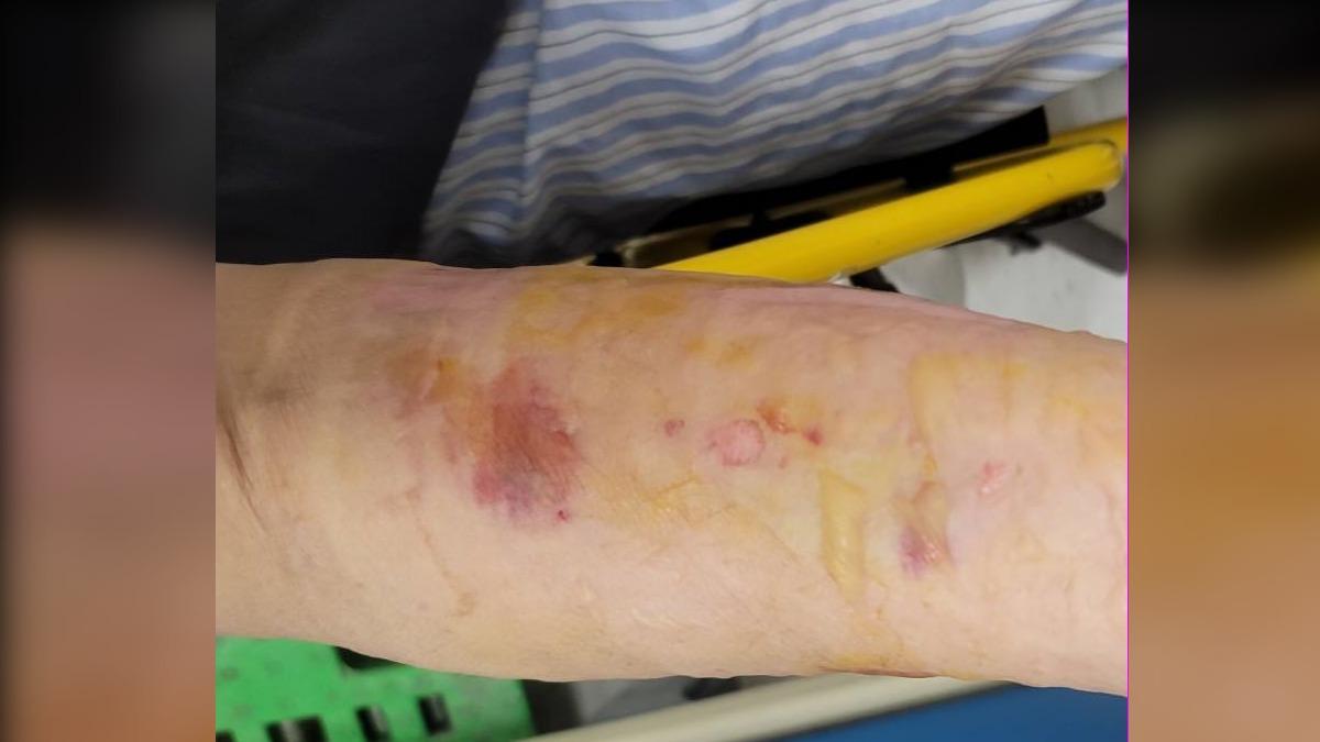蚊子叮抹大蒜泥可止癢?婦手臂又腫又爛險成「蜂窩性組織炎」