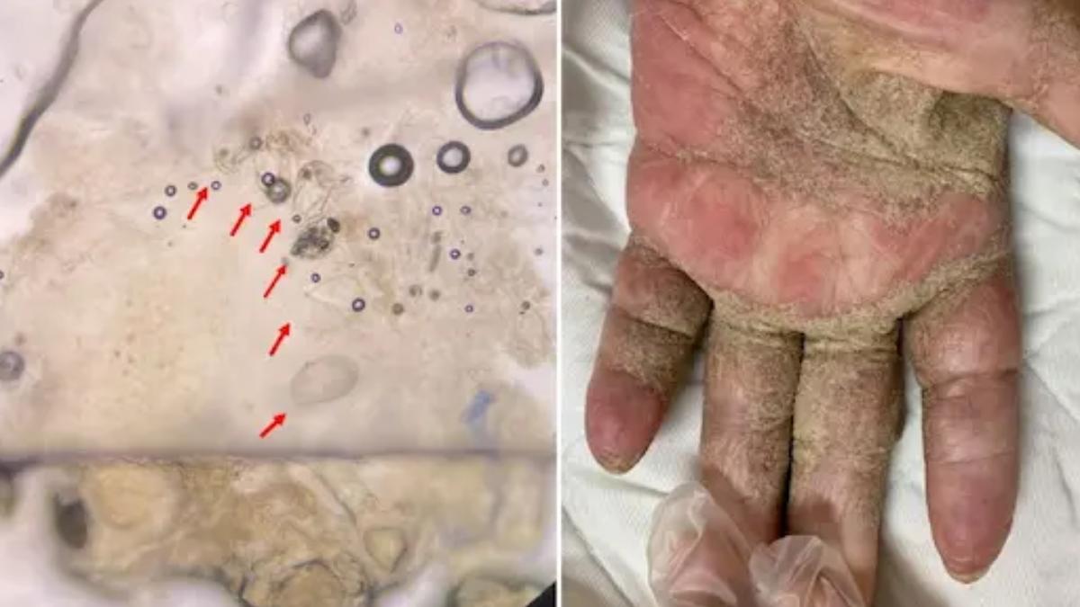 7旬老翁全身癢3個月!皮膚竟藏上千隻疥蟲 連家人也遭殃