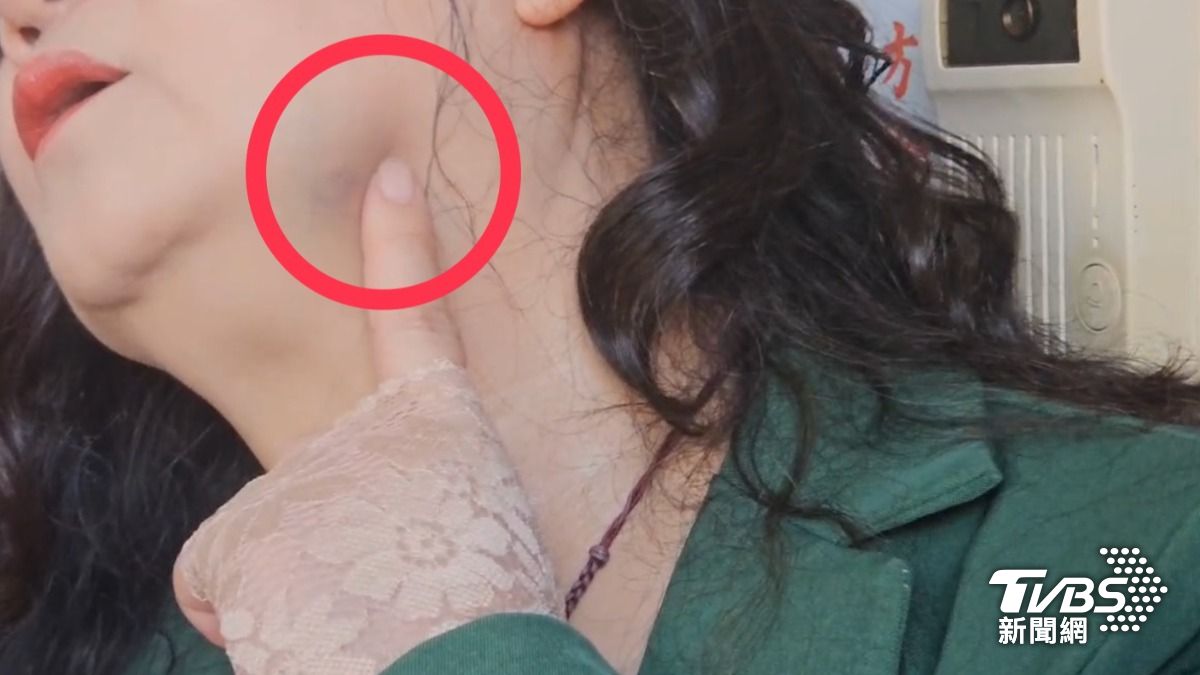 女房東反提告！控樋口飯糰夫婦「太野蠻」拳頭打到她牙碎裂