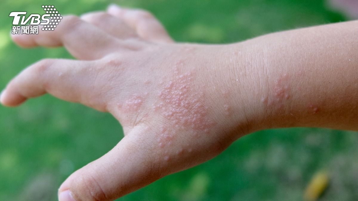 手腳冒小水泡超癢!「汗皰疹」1體質是真兇 日常5招預防