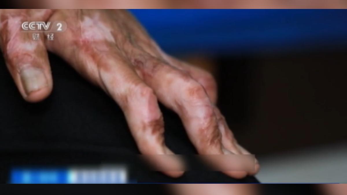 大陸青少年近年風靡吸食易燃丁烷，結果有人在恍惚中不慎引發氣爆，不僅身體皮膚大面積灼傷，最後連手指都伸不直。（圖／大陸央視）
