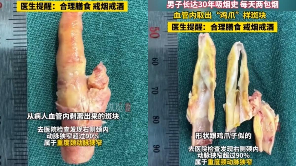 每天狂抽2包菸!陸男突看不見 體內取出「詭異雞腳硬塊」