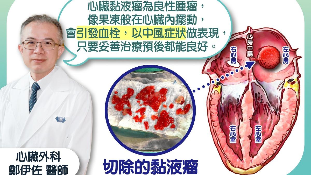 心臟黏液瘤是心臟內最常見的原發性良性腫瘤,約八成生長於左心房。(圖/慈濟醫院提供)