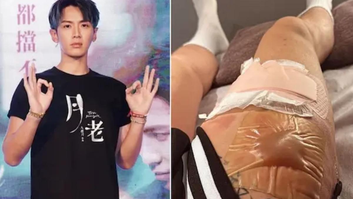 柯震東燙傷水泡腫成「水晶餃」 醫警告:亂貼人工皮恐感染