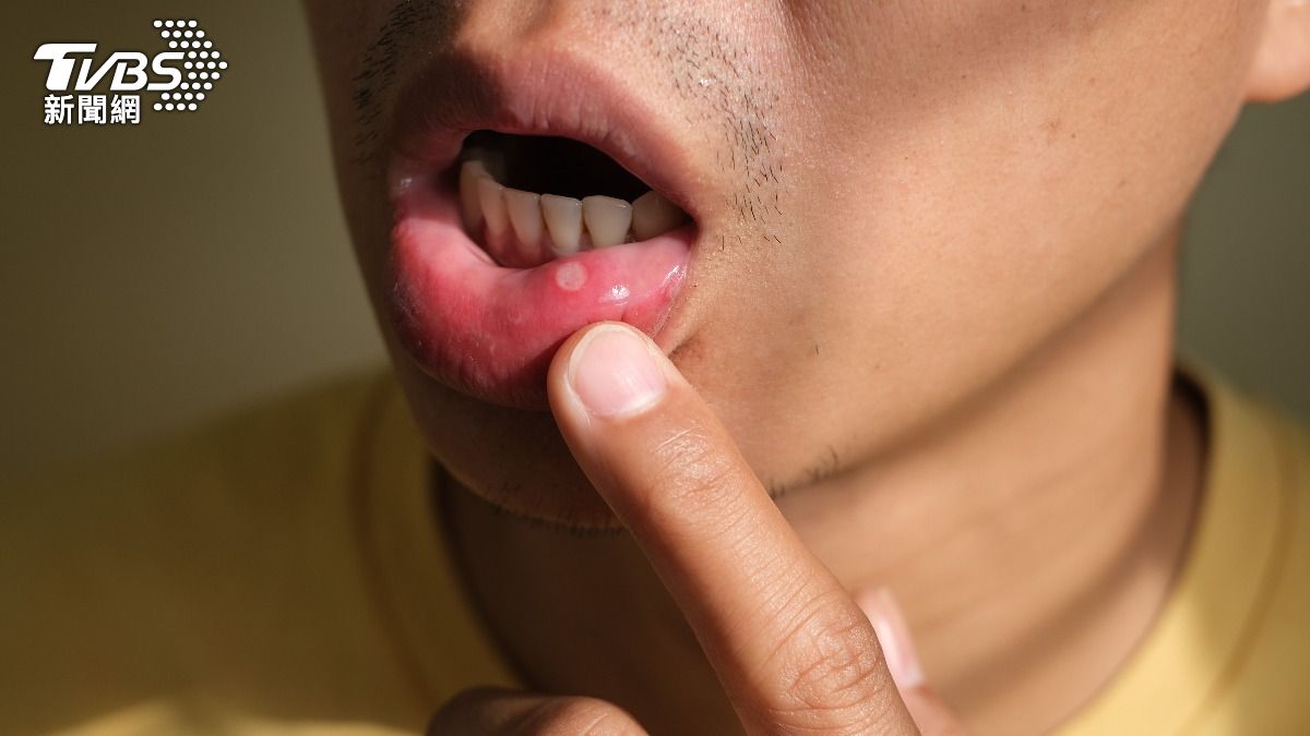 嘴破是因為火氣大?專家揭「3大口腔問題」 修復飲食對策一次看