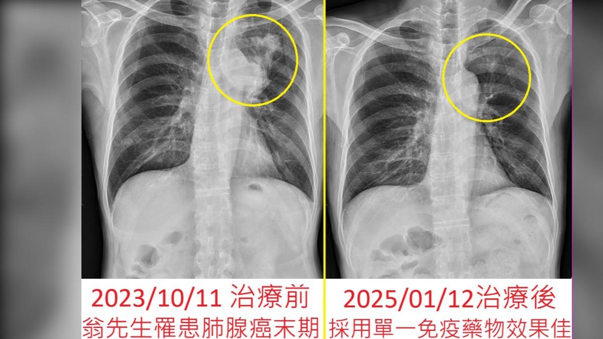 翁男一年前也罹患肺腺癌。(圖/烏日林新醫院提供)
