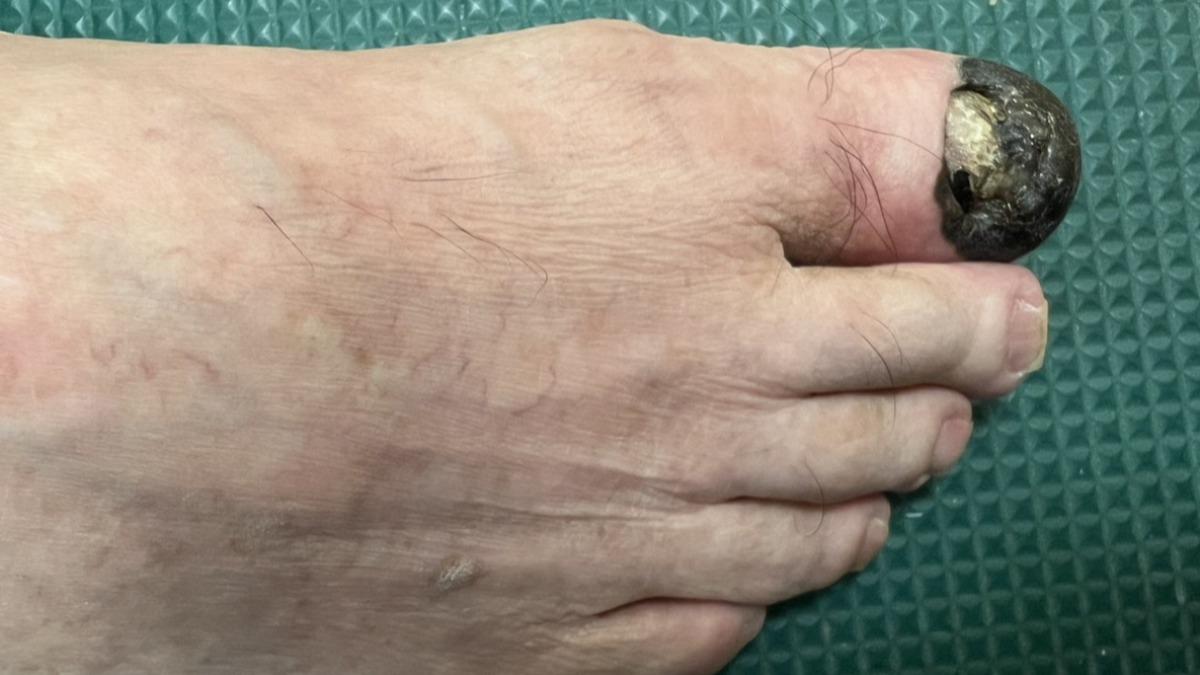 腳趾黑一塊不是瘀青!7旬翁罹皮膚癌長「黑色素瘤」險截肢
