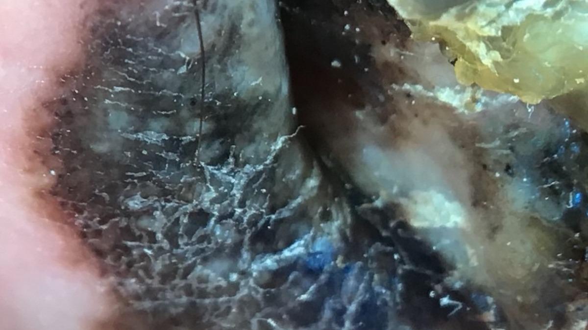 在皮膚鏡高倍顯像下,惡性黑色素瘤的黑色素顏色深淺不一,腫瘤邊緣不規則。(圖/台北慈濟醫院提供)