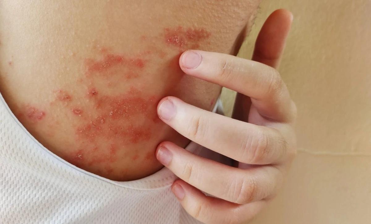 夏季濕疹的主因來自高溫、多汗、濕氣和悶熱，汗水和皮屑積聚，引發局部刺激和發炎。（示意圖／shutterstock達志影像）