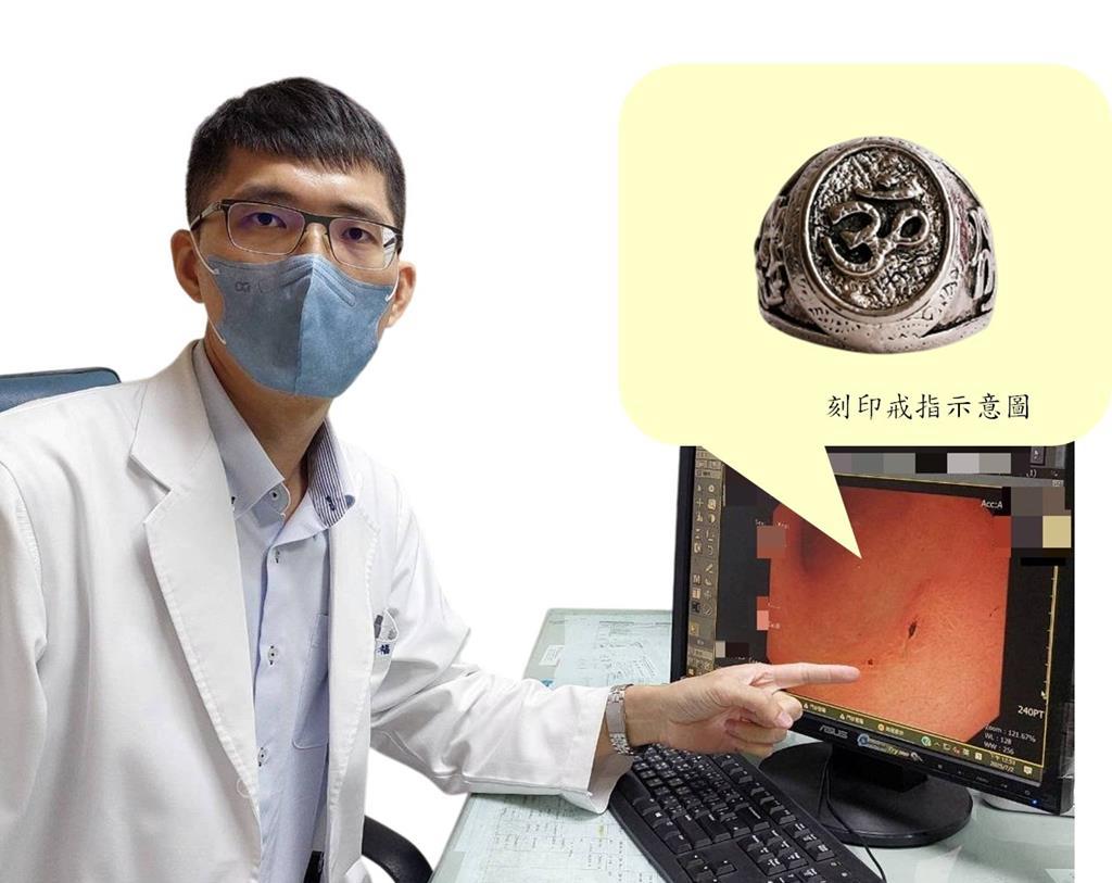 印戒細胞型胃癌因其形狀宛如刻印戒指而得名。(圖/大千醫院提供)