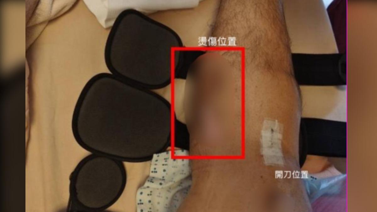 張先生開刀的是膝蓋,小腿卻出現燙傷。(圖/張先生提供)