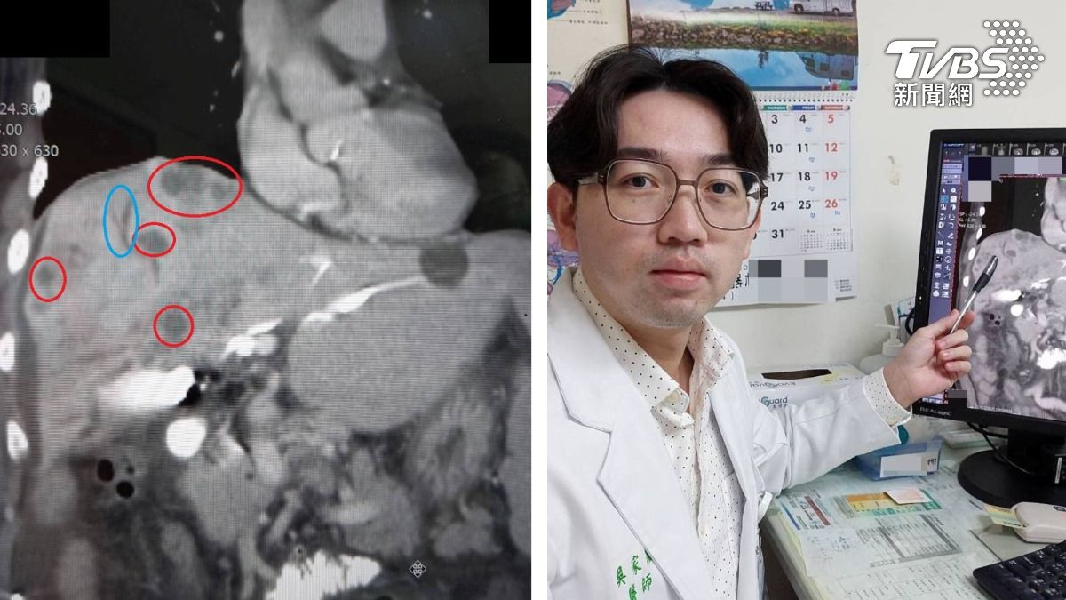 皮膚癢是癌末警訊！苗栗男體重狂掉4kg　一查肝臟佈滿腫瘤