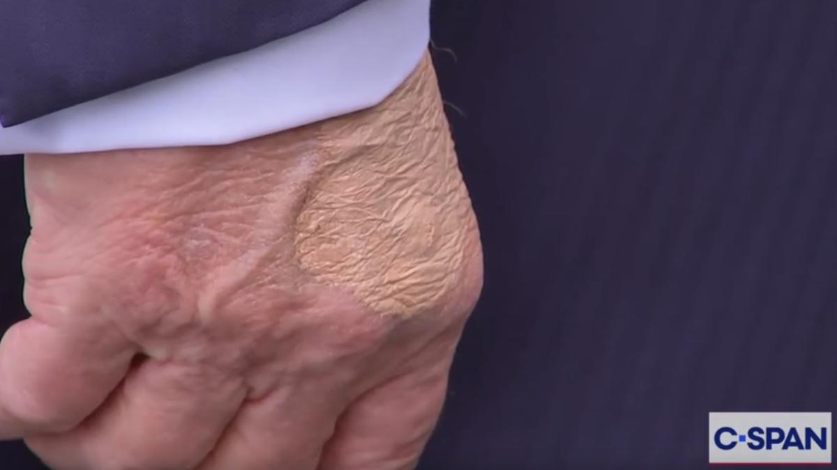 川普身體還好嗎?被拍到腳踝腫、手瘀青蓋遮瑕