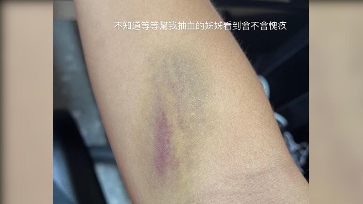學生抽完血後,手傷都是瘀青。(圖/受害學生授權提供)