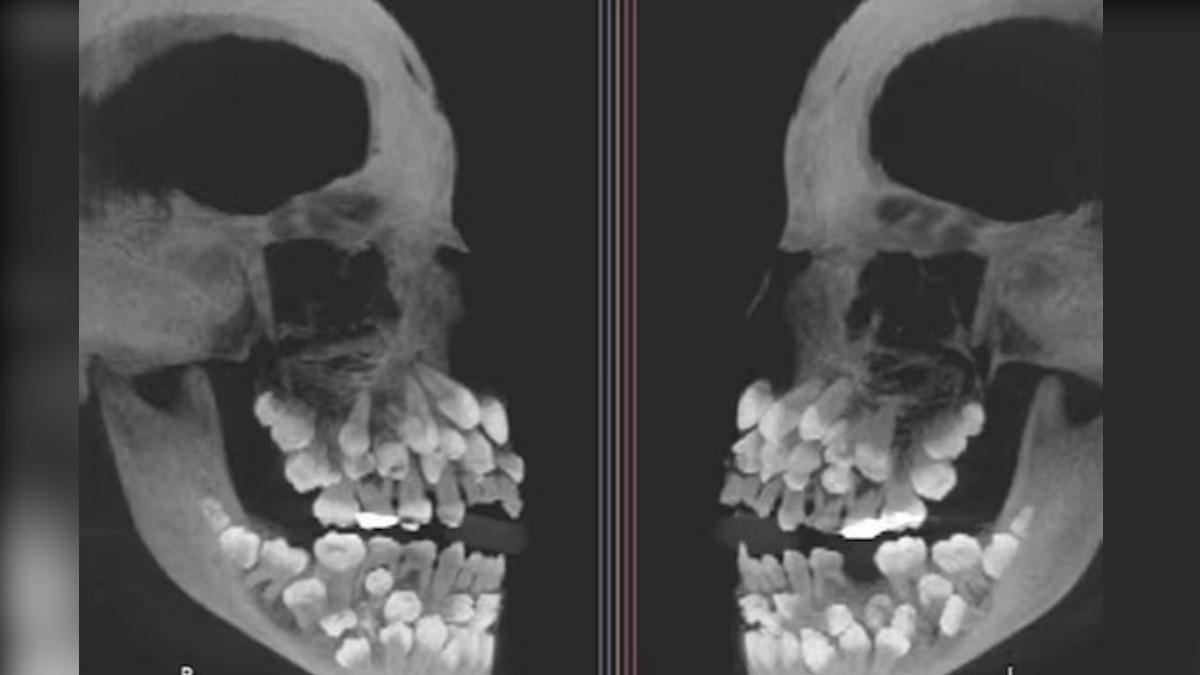 巴西女童拔牙就診 X光一照「竟有81顆牙」嚇壞牙醫