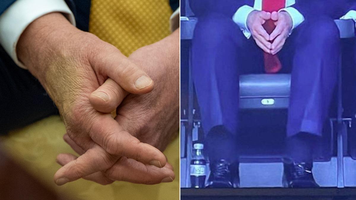 川普「腿腫手瘀青」照片瘋傳! 網友驚呼:英國女王死前也這樣