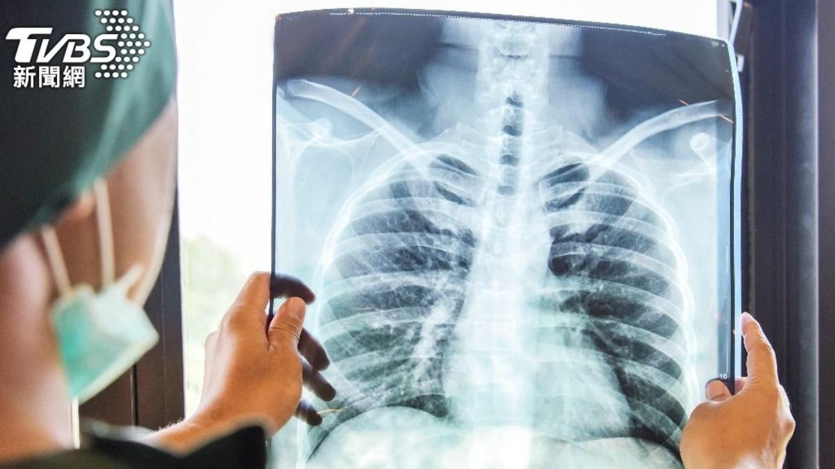 肺癌治療後「腫瘤長大1.5倍」!醫曝真相:不是壞消息