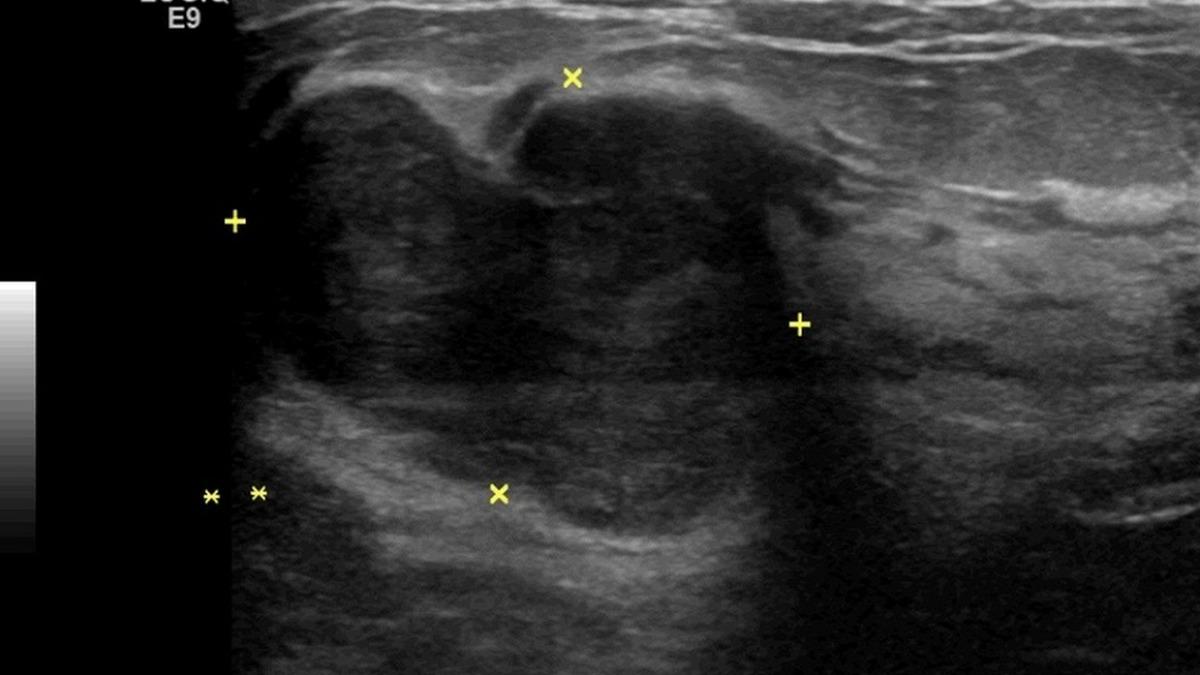 30歲女乳房摸到腫塊、快速變大！竟是葉狀瘤　醫：有惡性潛能