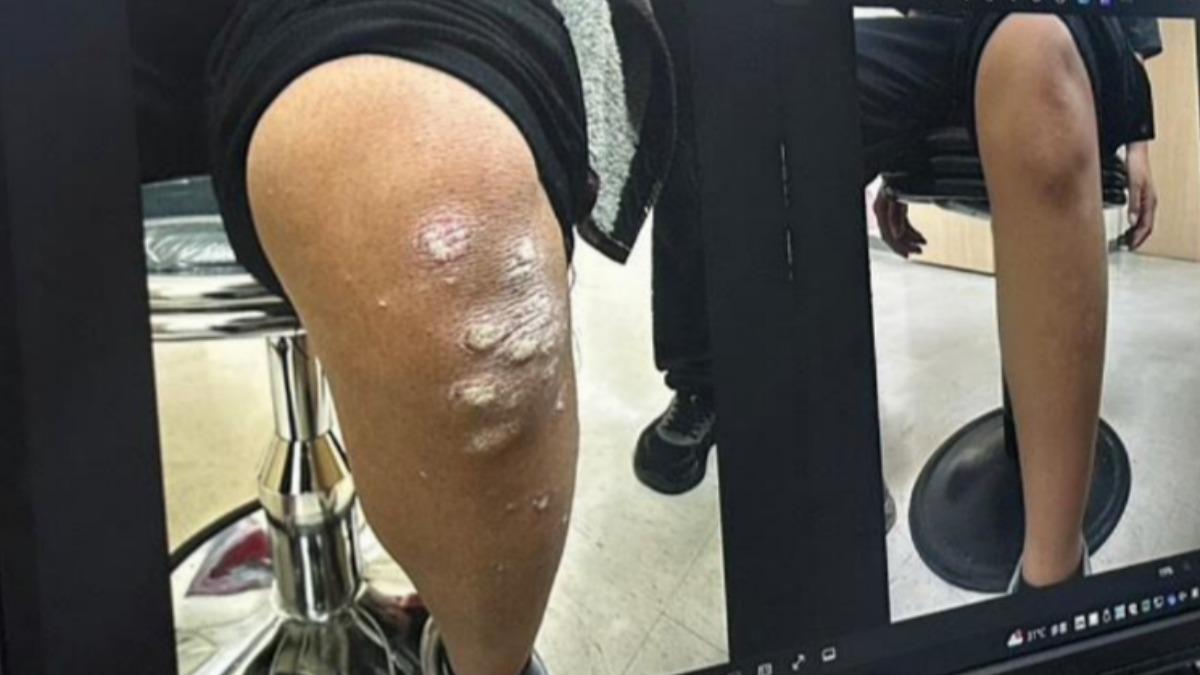 台中市一名就讀國小六年級的12歲女童，3月時頭皮、手肘、膝蓋與小腿突冒大片乾癬。（圖／豐原醫院提供）