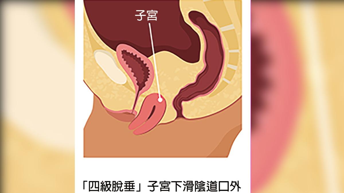 走路卡卡!三寶媽忍10年 「子宮脫垂」露出5公分急開刀