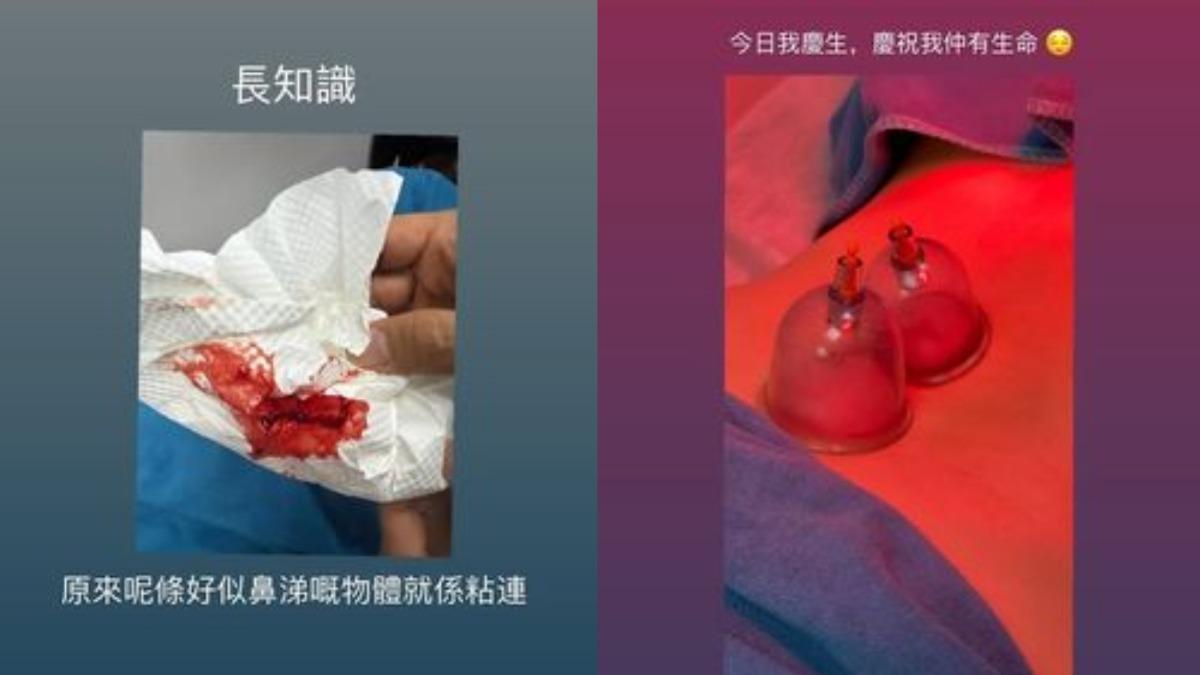 李幸倪近日傳出健康亮紅燈的警訊，並曬出拔罐放血的治療畫面。（圖／翻攝自李幸倪IG）