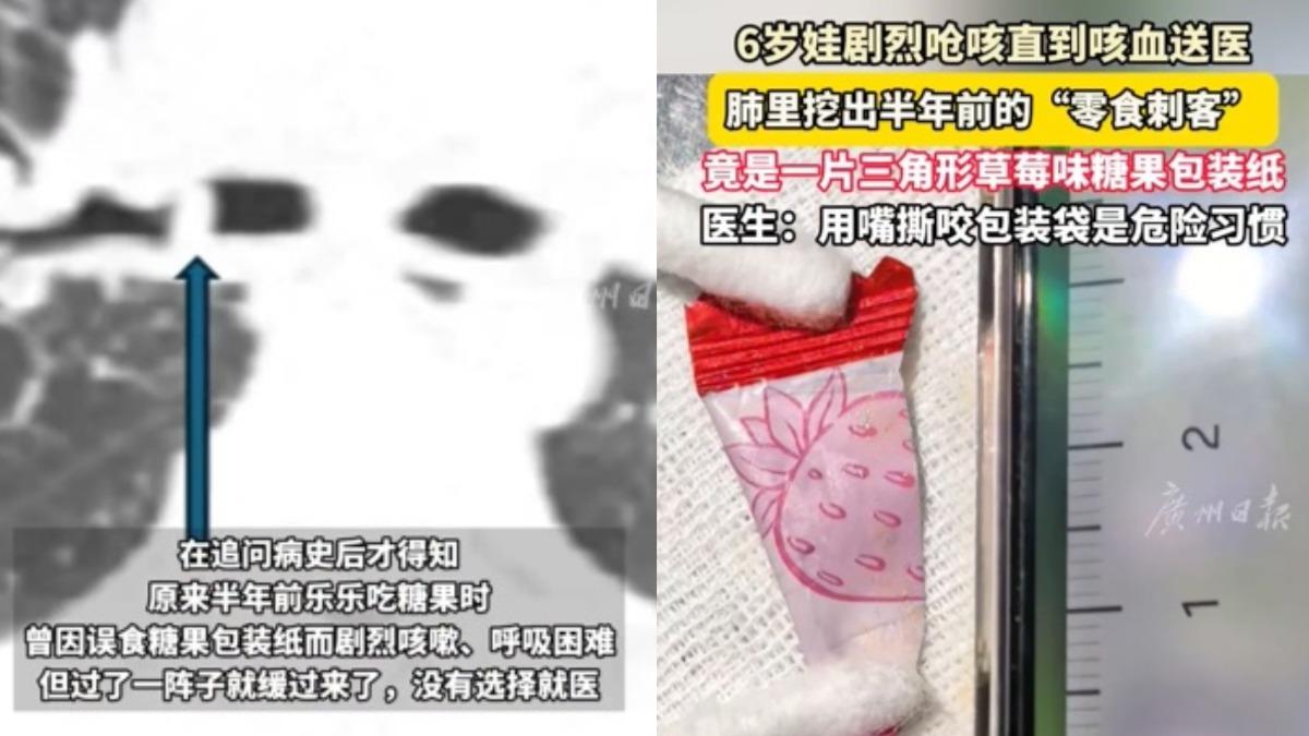 陸童-誤食-糖果包裝紙-嗆咳