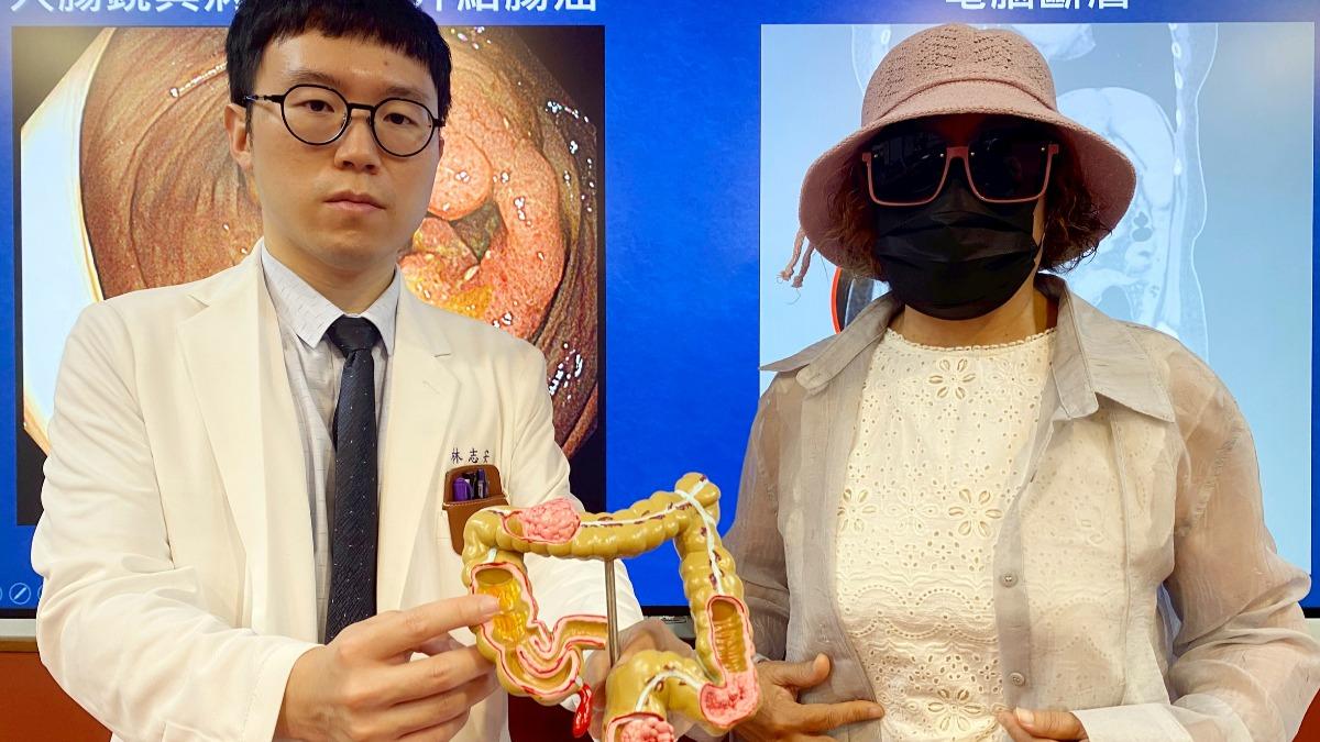 林志安(左)說明,每年全台約有2500至3400人和吳女(右)一樣,一發現即是大腸癌末期。(圖/台中榮總提供)