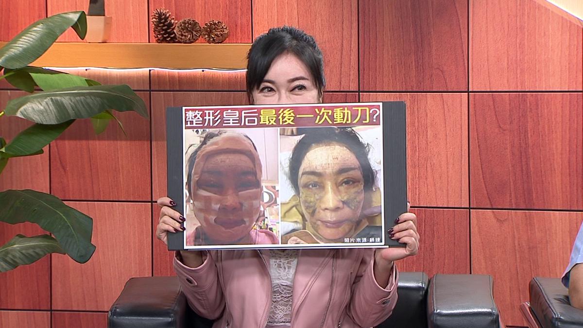 顧婕今年施作三層筋膜大拉皮手術。（圖／年代提供）