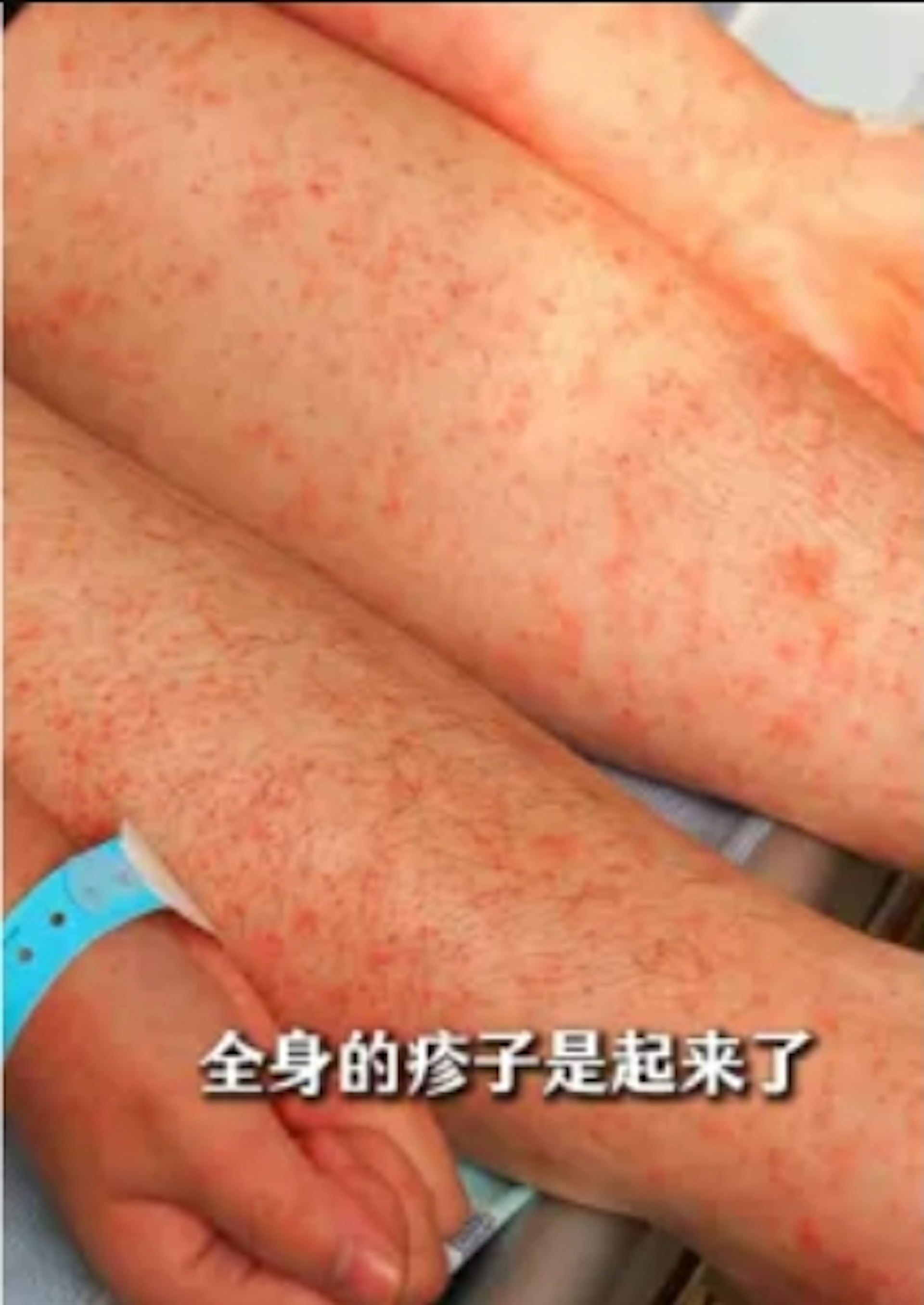 大陸佛山三水區政府發布多張患者出現皮疹的照片。(圖/翻攝自大陸佛山三水區政府公眾號)