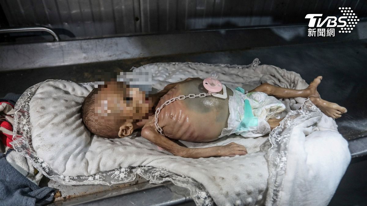 因嚴重營養不良過世的嬰兒。(圖/達志影像美聯社)