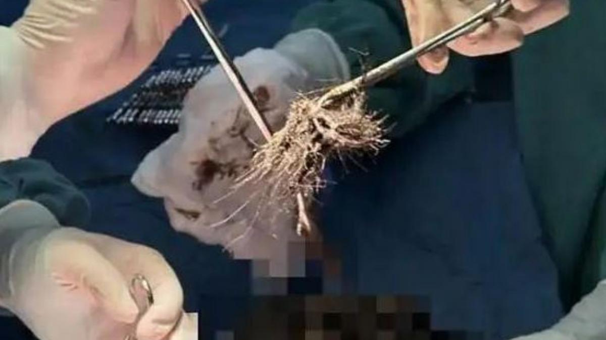 陸15歲少女患「長髮公主症」狂吃髮 醫取出2公斤髮石傻眼