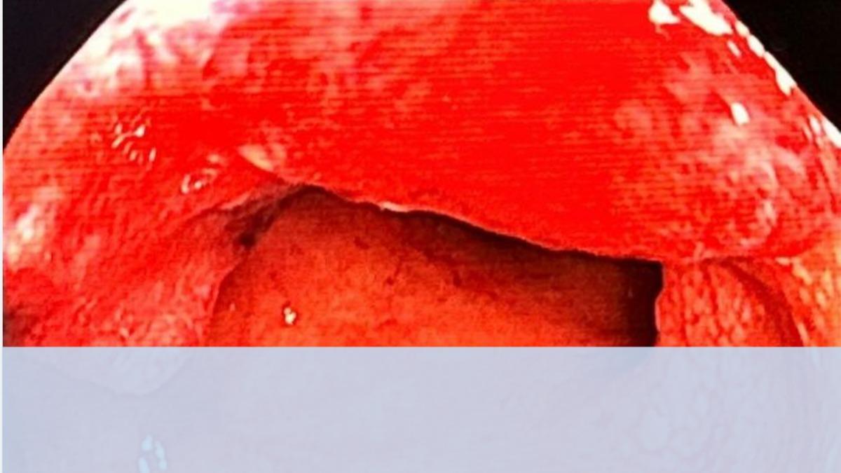 排便注意4徵兆!台中男噴血以為吃藥副作用 拖一年才知罹癌