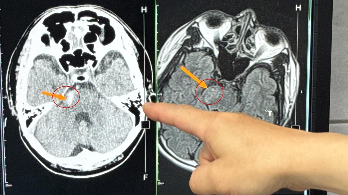 狂抽菸腦幹出血!醫嘆非死即癱瘓 他只求陪孩子…奇蹟出現了